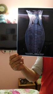 Stomach xray to see blockage in intestine